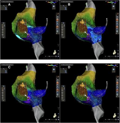 Atrioventricular nodal reentry tachycardia treatment using CARTO 3 V7 activation mapping: a new era of slow pathway radiofrequency ablation is under coming